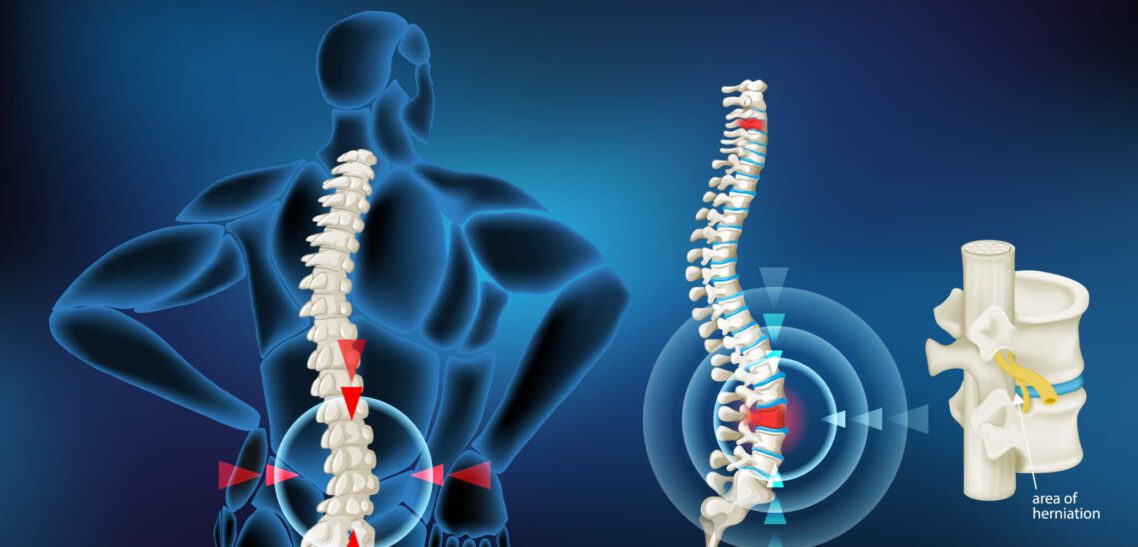 Discopathy – study, result, treatment, exercise Discopathy
